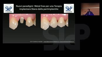 Nuovi paradigmi metal free per una terapia implantare libera da peri-implantite