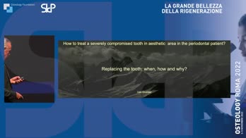 COME TRATTARE IL DENTE GRAVEMENTE COMPROM ESSO IN ZONA ESTETICA NEL PAZIENTE PARODONTALE? - Sostituire il dente: quando, come e perché?
