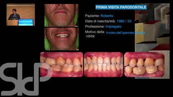 Complete periodontal therapy of a Stage 3 Grade C periodontitis in  a 50 yo man