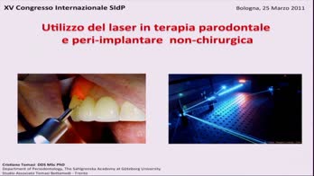 Utilizzo del laser in terapia parodontale perimplantare non chirurgica