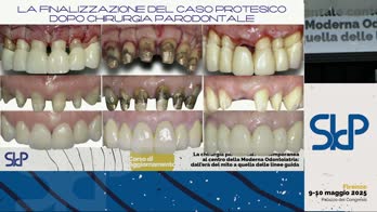 La finalizzazione del caso protesico dopo chirurgia parodontale
