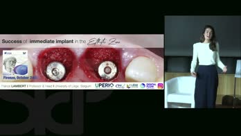 Successo degli impianti immediati nelle zone estetiche