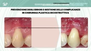 🇮🇹 In chirurgia plastica ricostruttiva
