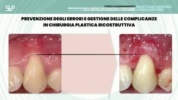 🇬🇧 In chirurgia plastica ricostruttiva